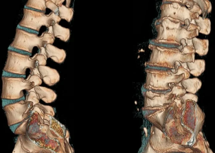 the osteochondrosis