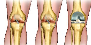 what is osteoarthritis