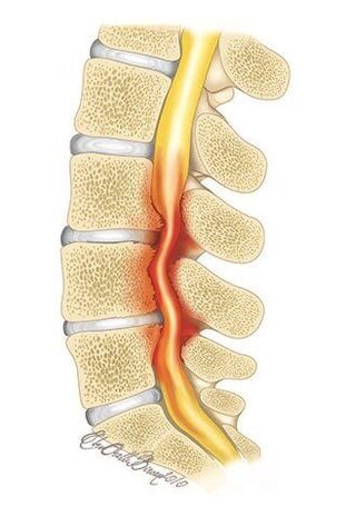With osteochondrosis of the thoracic spine, compression of the spinal canal occurs.