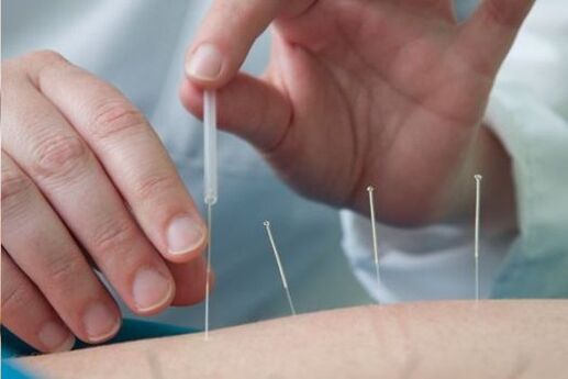 Acupuncture a method of treating pain in the lumbar region caused by osteochondrosis.