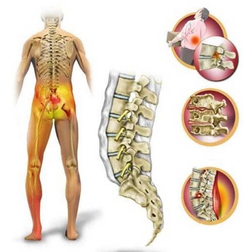 Osteochondrosis of the lumbar spine, which causes back pain.