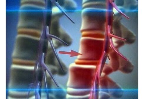 Squeeze nerve endings in lumbar osteochondrosis