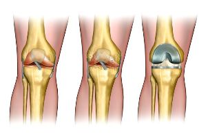 the degree of osteoarthritis