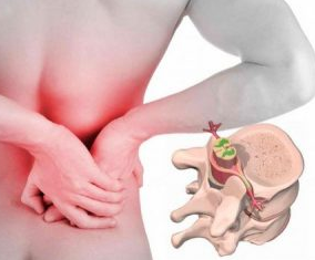 Low back pain in the beginning of the disease, osteochondrosis