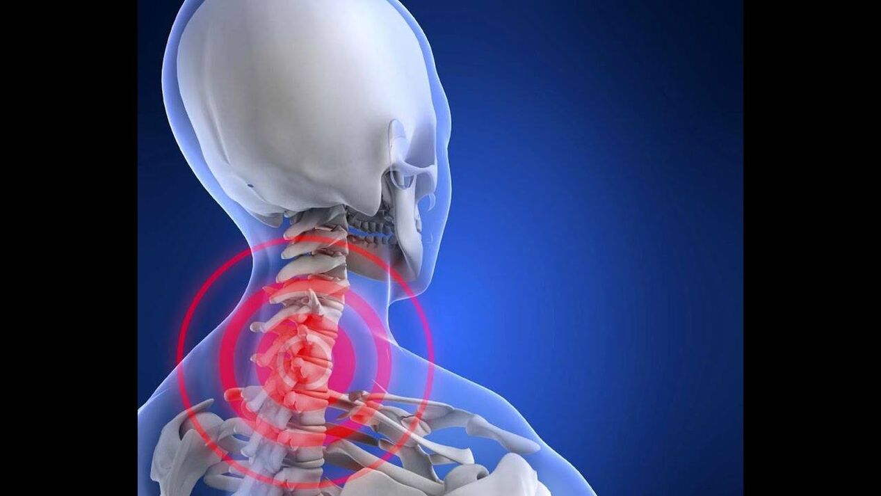 Osteochondrosis of the cervical column