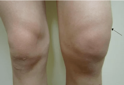 Knee joint hemartrosis