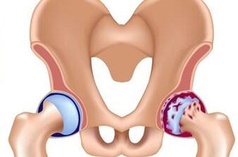 Stages of development of the arthrosis of the hip joint