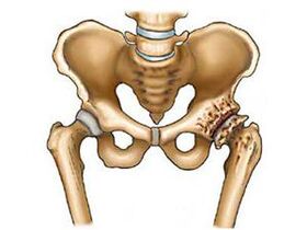What is the osteoarthritis of the hip joint