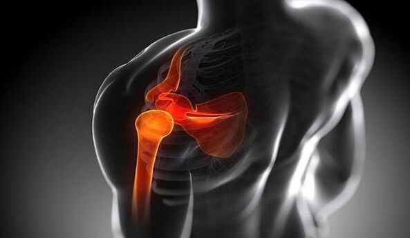 Damage to the shoulder joint due to osteoarthritis.