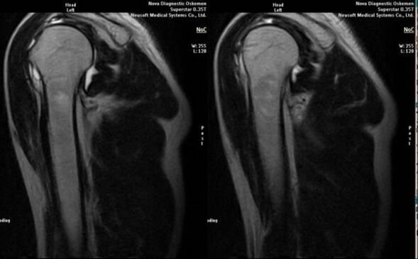 X-ray to diagnose shoulder osteoarthritis.