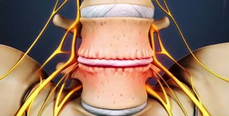 Spinal injuries due to osteochondrosis.